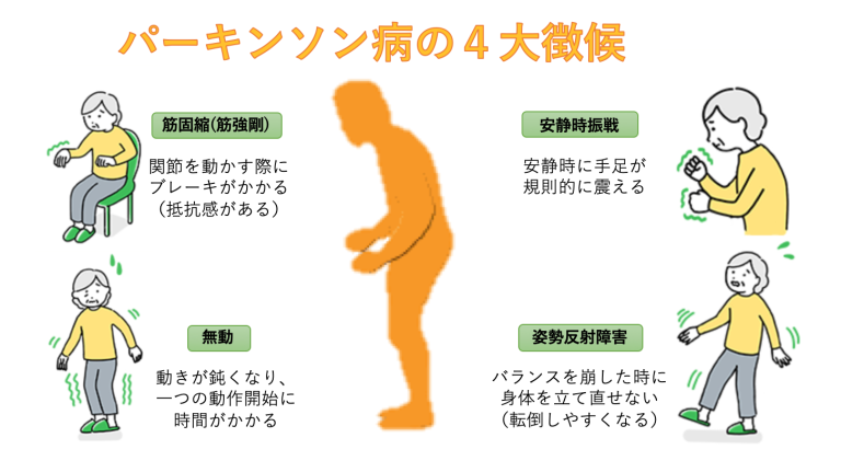 パーキンソン病って何？ - 静岡リハビリセンター｜静岡市清水区｜リハビリ専門店｜リハビリ