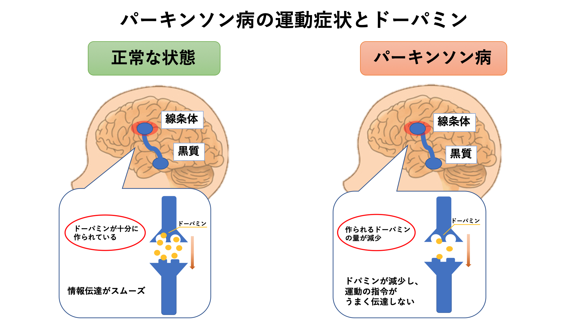 パーキンソン病って何？ - 静岡リハビリセンター｜静岡市清水区｜リハビリ専門店｜リハビリ